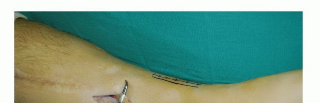 Illustration 39 for Foot Drop Surgery: How a Pin or Drill Elevates Tendon Transfer