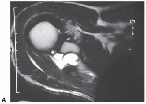 Illustration 7 for Decompressing the Transverse Scapular Ligament for Shoulder Pain Relief