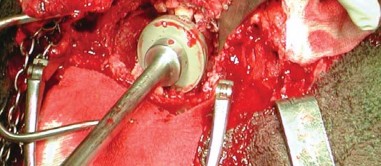 Illustration 24 for Expert Bone Grafting for Primary Total Hip Replacement Success