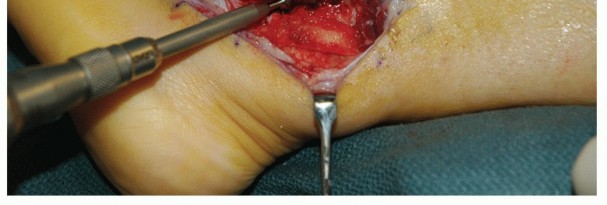 Illustration 24 for Beyond Primary Repair: Solutions for Peroneal Tendon Subluxation