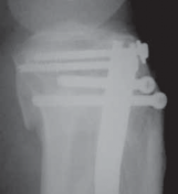 Illustration 60 for Optimal Nailing of the Tibia: Techniques for Challenging Fractures