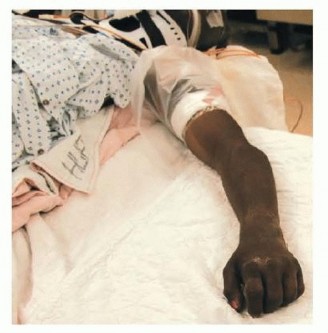 Illustration 5 for Effective K-Wire Fixation: Distal Radius Fractures Without External Fixation