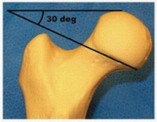 Illustration 2 for Is a Sliding Hip Screw Best for Your Femoral Neck Fracture?