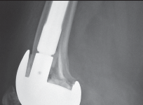 Illustration 70 for Mastering Gap Balancing in Revision TKA: Avoid Common Pitfalls