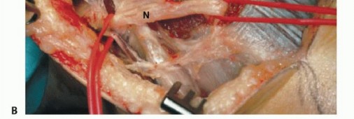 Illustration 3 for Beyond Amputation: The Type I Resection in Fibular Tumor Surgery