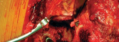 Illustration 58 for Cemented Component Longevity: The Critical Margin of the Acetabulum