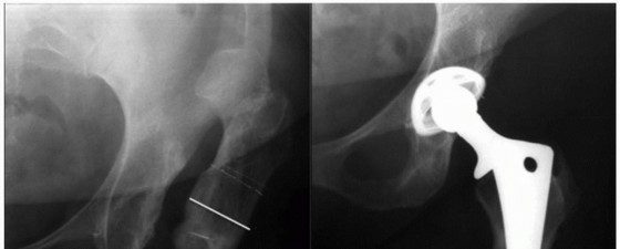 Illustration 21 for Extensively Porouscoated Stems: Proven Success & Superior Fixation