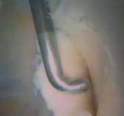 Illustration 11 for Resolving Femoral Head Neck Impingement: Arthroscopic FAI Solutions