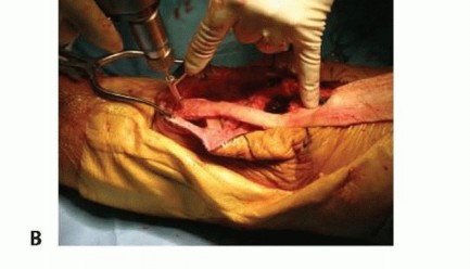 Illustration 12 for Patella Tendon Rupture Reconstruction in Revision TKA