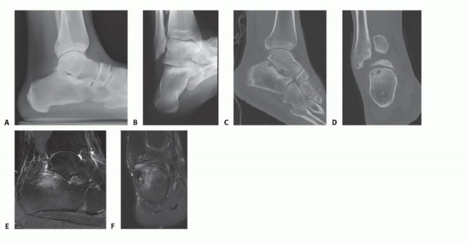 Navigating the posterior calcaneal facet in Subtalar Arthroscopy