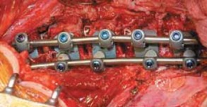 Illustration 48 for Mastering Anterior Interbody Arthrodesis with Instrumentation for Scoliosis