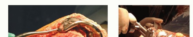 Illustration 4 for Removal of Well-fixed Components: Safe Techniques for Revision TKA