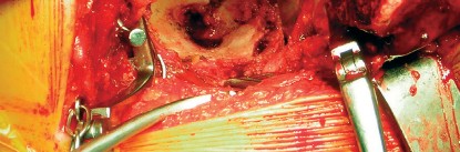 Illustration 38 for Cemented Component Longevity: The Critical Margin of the Acetabulum