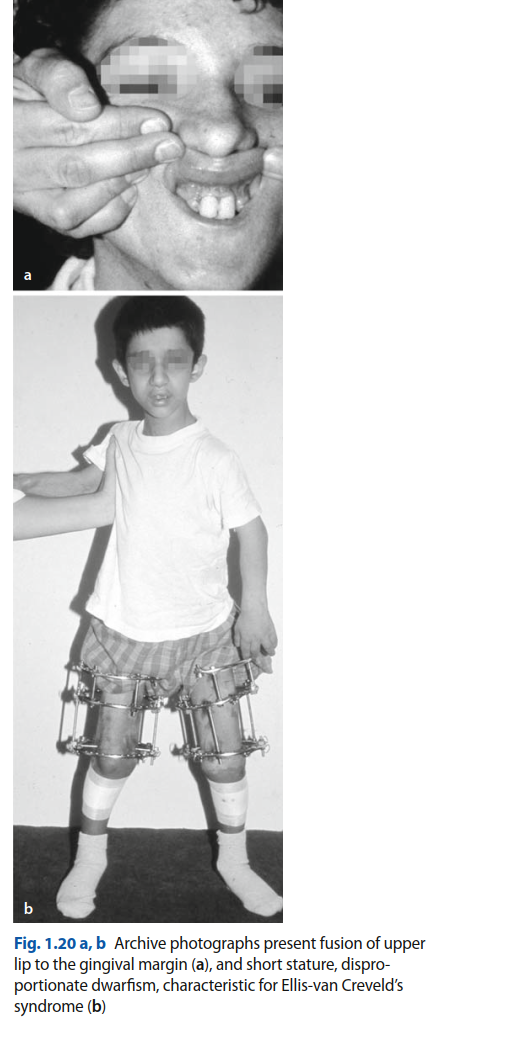 Ellis-Van Creveld's Syndrome: Uncover Key Orthopedic & Oral Signs