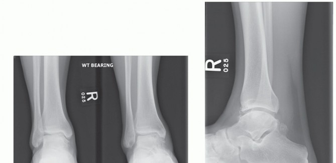 Illustration 22 for Unlock Healing: Medial Malleolar Osteotomy for Talus OLT Allografts