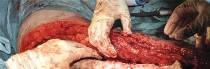 Illustration 81 for Optimizing Infected THA: The One Staged Approach Explained