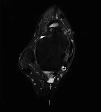 صورة توضيحية لـ التهاب وتر قابضة إبهام القدم الطويلة ومتلازمة العظم المثلث في راقصات الباليه دليل شامل