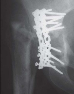 Illustration 4 for Management of Periprosthetic Fractures: An Expert Surgical Guide