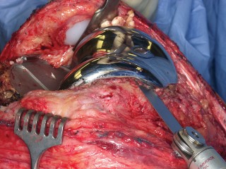 Illustration 21 for PROSTALAC Articulating Spacer: Treat Infected Knees, Regain Mobility