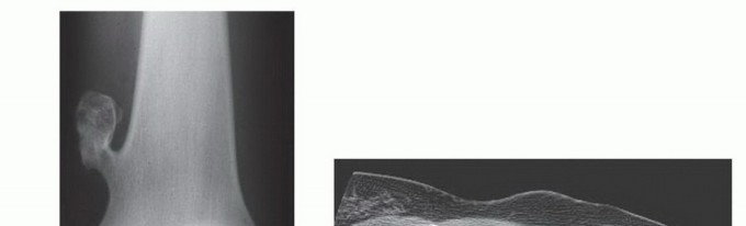 Illustration 24 for Precision Biopsy of Musculoskeletal Tumors for Accurate Diagnosis