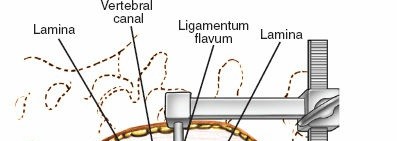 Illustration 14 for Approach to the Lumbar Spine: Mastering Techniques & Anatomy
