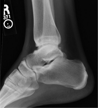 Ballet Dancer's Ankle: Is Total Ankle Arthroplasty the Answer?