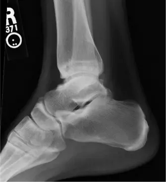 مفصل الكاحل الصناعي لراقصات الباليه: حل شامل لخشونة الكاحل المتقدمة