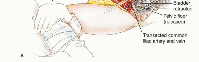 Illustration 21 for Posterior Flap Hemipelvectomy: Mastering Techniques for Optimal Outcomes
