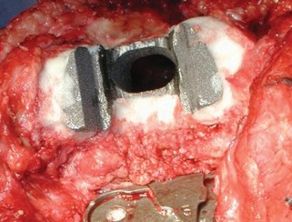 Illustration 18 for Porous Metal Cones: Biologic Fixation for Severe Bone Loss