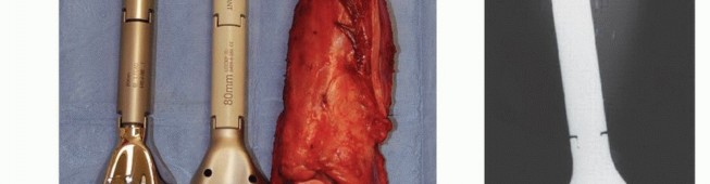 Illustration 16 for Distal Femoral Replacement: Key to Modern Limb Salvage