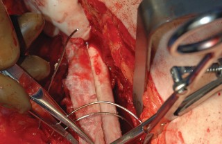 Illustration 86 for Femoral Stem Revision: Posterior Approach for Better Outcomes