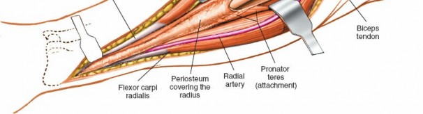 Illustration 17 for Radius Anterior Approach: Safe Nerve Protection & Complete Exposure