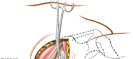 Illustration 8 for Pelvis & Acetabulum Approaches: Unlocking the Posterior Superior Iliac
