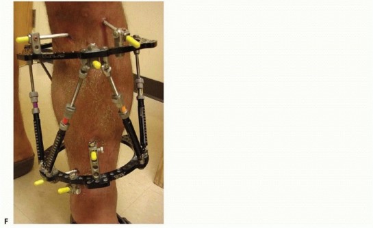 Illustration 7 for Tibia External Fixation: See How Pins Are Placed for Healing