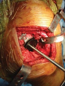 Illustration 32 for Optimizing Arthroplasty in Acute Fractures: Octopus System