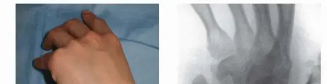 صورة توضيحية لـ كسر العظم الزورقي في الرسغ: دليل شامل للمريض نحو الشفاء التام مع الأستاذ الدكتور محمد هطيف