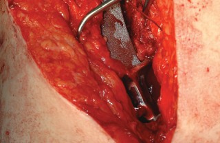 Illustration 89 for Femoral Stem Revision: Posterior Approach for Better Outcomes