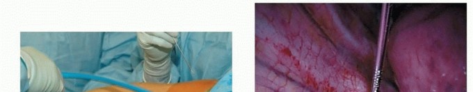 Illustration 9 for Anterior Interbody Arthrodesis for Scoliosis: What You Need to Know