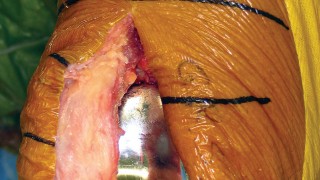 صورة طبية: استبدال مفصل الركبة بالحد الأدنى من التدخل الجراحي: ألم أقل وتعافٍ أسرع مع النهج شبه الرضفي الإنسي