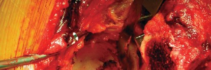 Illustration 37 for Cemented Component Longevity: The Critical Margin of the Acetabulum