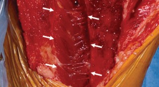 Illustration 26 for Precision Soft Tissue Balancing in Revision: Avoid TKA Pitfalls