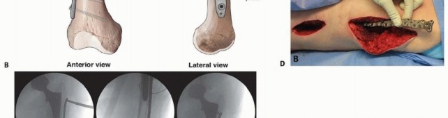 Illustration 27 for Mastering Fixation of Periprosthetic Fractures of the Femur