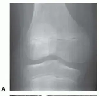 صورة توضيحية لـ الغضروف الهلالي القرصي: دليلك الشامل من التشخيص للعلاج والتعافي مع الأستاذ الدكتور محمد هطيف
