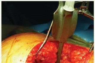 Illustration 14 for Cemented Acetabular Component: Achieving Optimal THA Stability