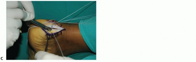 Insertional Achilles Tendinopathy: Causes, Symptoms & Relief