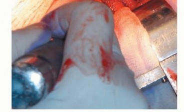 Illustration 48 for Hemiarthroplasty of the Hip: Indications & Types Explained