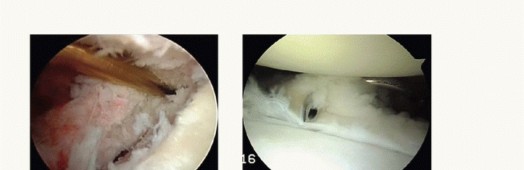 Illustration 16 for Regain Stability: Arthroscopy for Anterior Instability & the Inferior Glenohumeral Ligament
