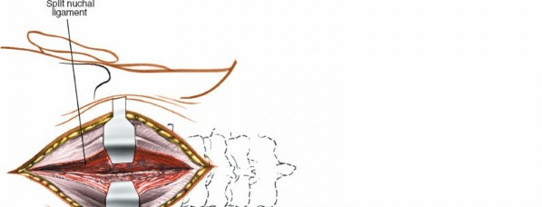 Illustration 226 for Approach to the Lumbar Spine: Mastering Techniques & Anatomy