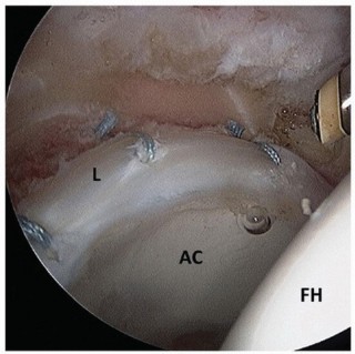 Illustration 27 for Beyond Knee Surg: Hip Arthroscopy for Sports Injuries