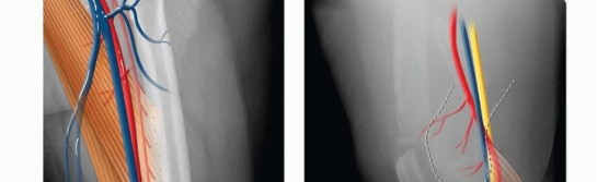 Illustration 5 for Repairing Distal Femur Fractures: Open Reduction & Internal Fixation